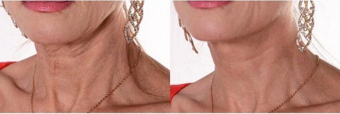 Beauty-čudno: zašto žene ljepilo traka na vratu